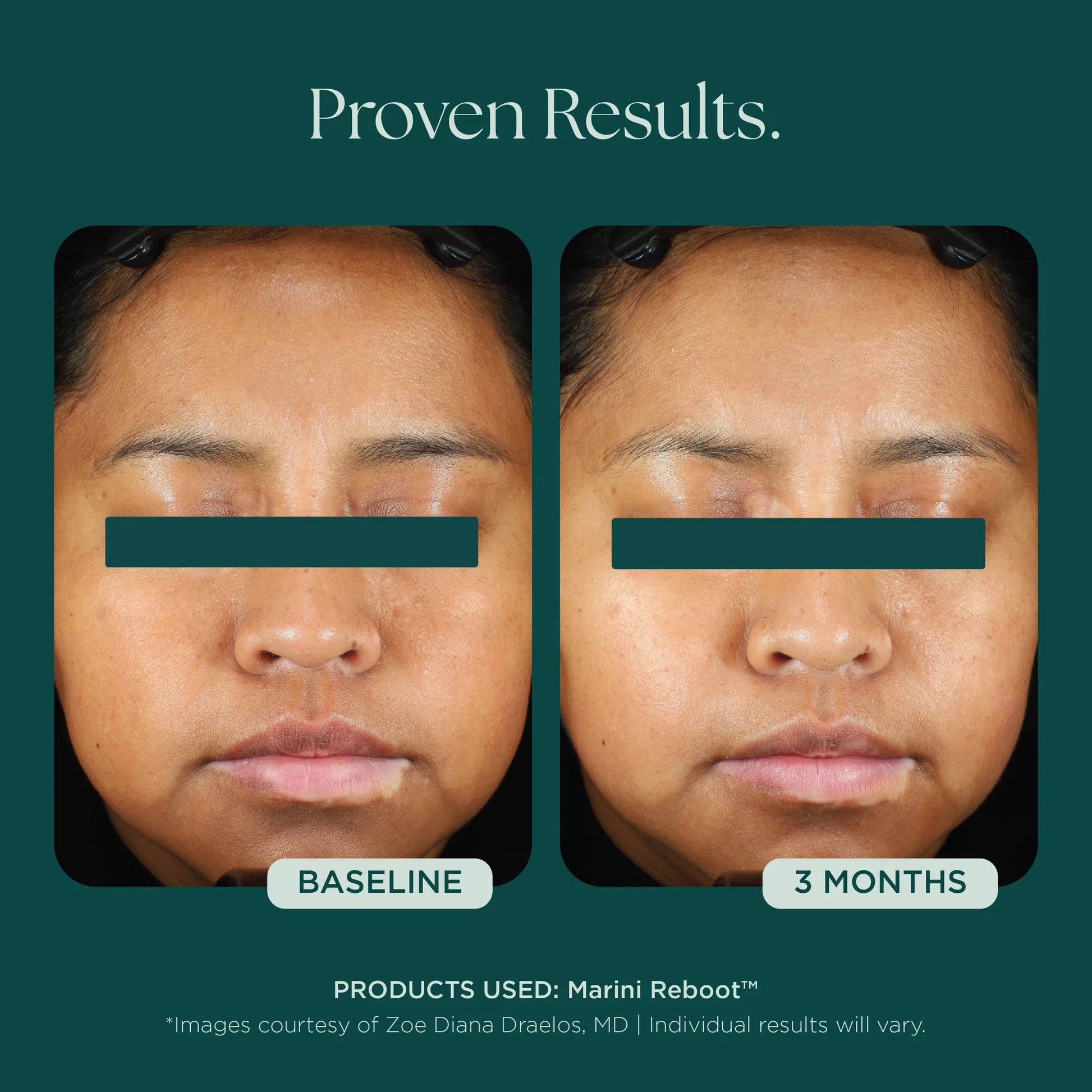 Marini SkinSolutions - Marini Reboot® PDRN Face Serum | SKINSTUDIO