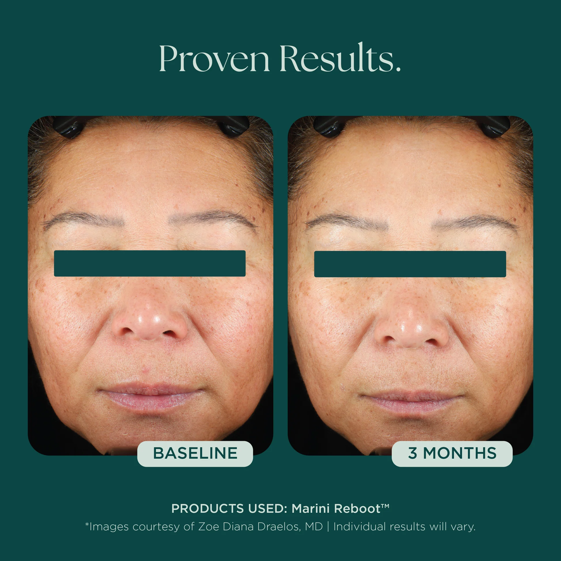 Marini SkinSolutions - Marini Reboot® PDRN Face Serum | SKINSTUDIO