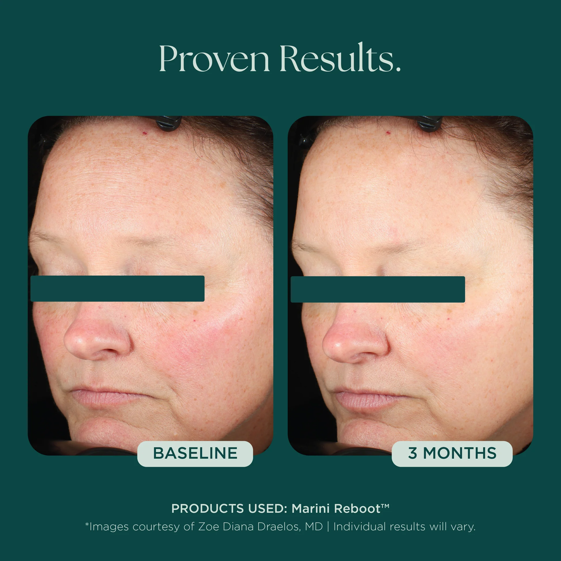 Marini SkinSolutions - Marini Reboot® PDRN Face Serum | SKINSTUDIO